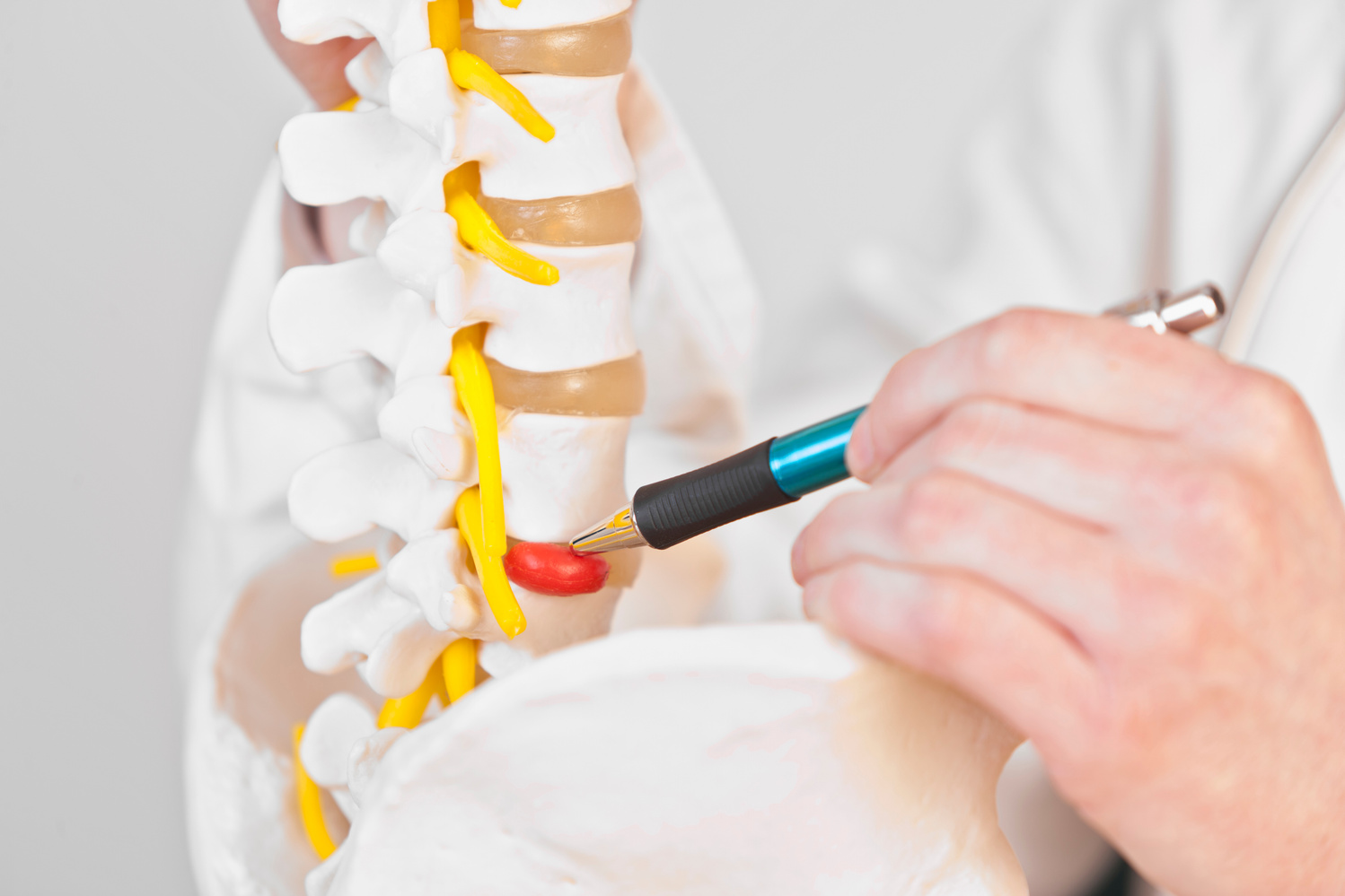 Lumbar disc herniation